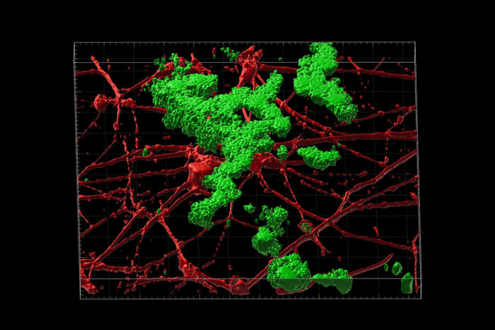 Shown is a 3D reconstruction of amyloid beta plaque deposition (green) between neurons (red) grown in the lab. These neurons were transformed from human skin cells taken from patients with late-onset Alzheimer's disease.