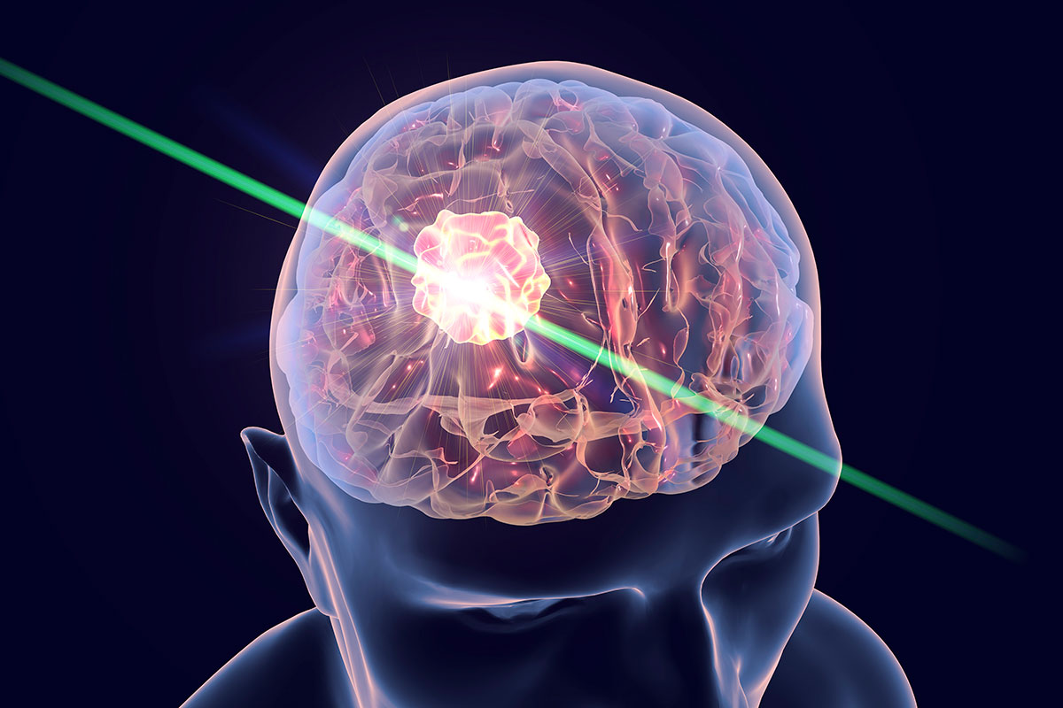 Lasers help fight deadly brain tumors – Washington University School of
