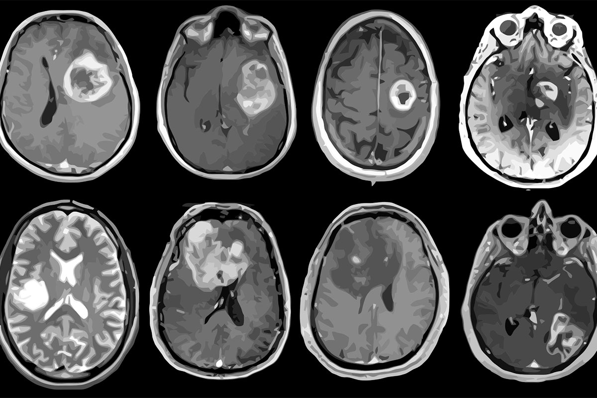 Alert snave bekymre Aggressive brain tumor mapped in genetic, molecular detail – Washington  University School of Medicine in St. Louis
