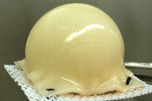 A 3-D, biodegradable, synthetic scaffolding has been molded into the precise shape of a hip joint. The scaffold is covered with cartilage made from stem cells taken from fat beneath the skin. 