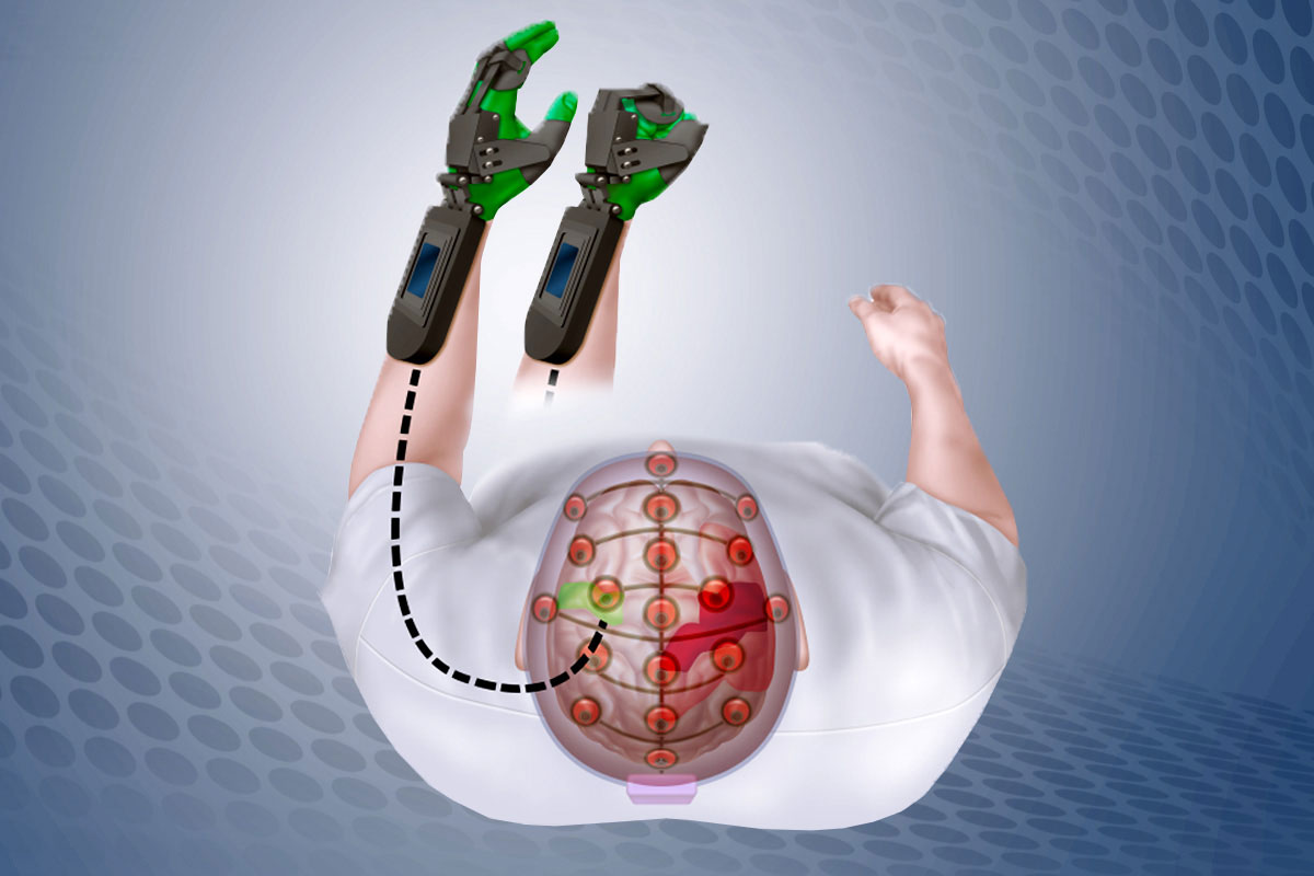 The Ipsihand detects electrical signals in the uninjured part of the brain (green), and opens and closes a plastic brace fitted onto the paralyzed hand (green). By doing so, it helps train the uninjured brain areas to take over functions previously performed by injured areas (red).