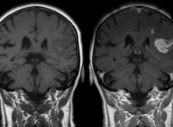 MRI of an ischemic stroke in the brain without (left) and with (right) contrast.