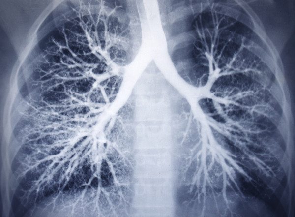 Lung-X-Ray