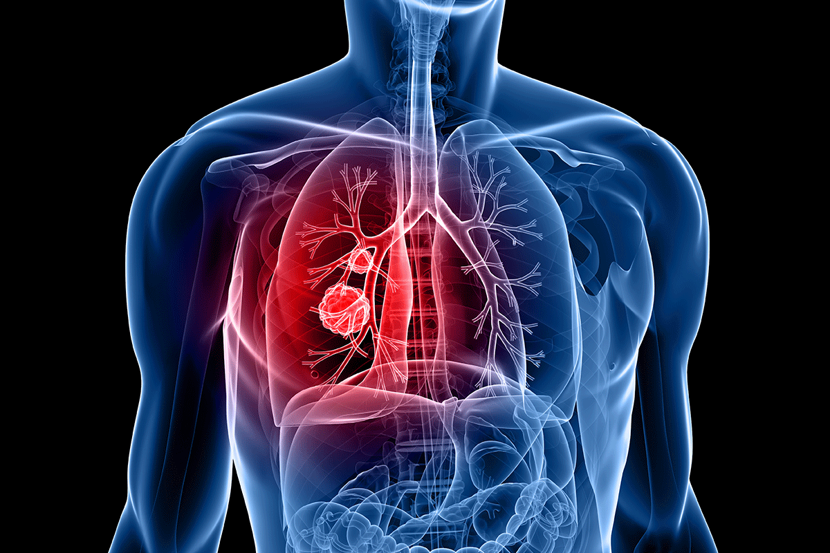 La biopsie liquide pourrait guider les décisions de traitement pour le cancer du poumon oligométastatique – École de médecine de l’Université de Washington à St. Louis