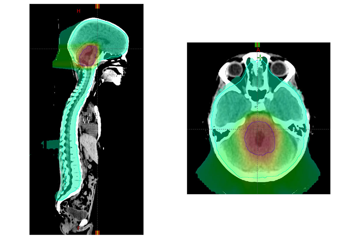 Higher doses of radiation don't improve survival in prostate