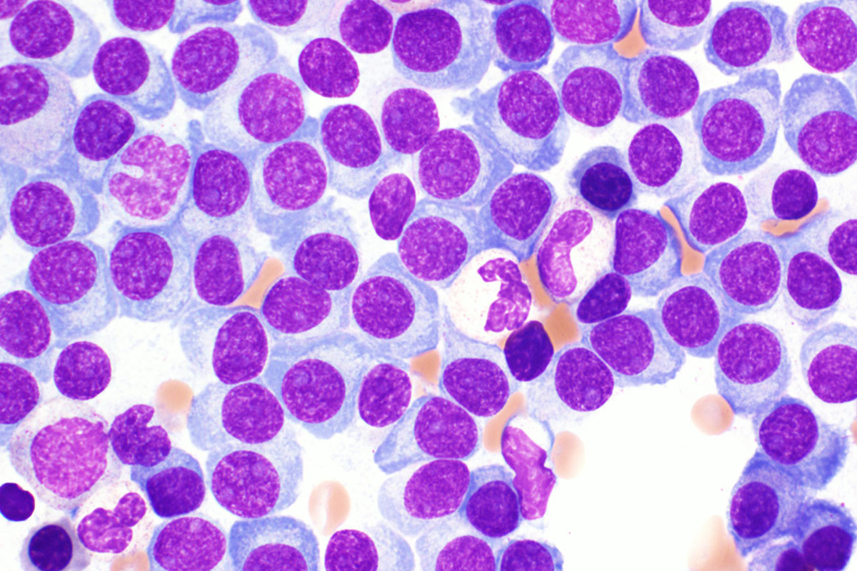 Investigational drug may improve stem cell transplantation for multiple myeloma patients – Washington University School of Medicine in St. Louis
