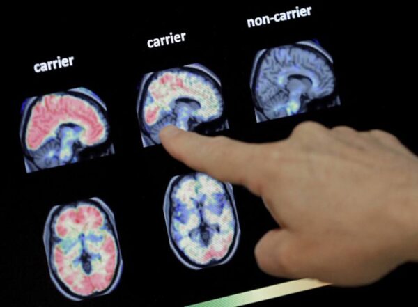 In this Aug. 14, 2018 file photo, a doctor looks at a PET brain scan at the Banner Alzheimers Institute in Phoenix. Two experimental drugs failed to prevent or slow mental decline in a study of people who are virtually destined to develop Alzheimer's disease at a relatively young age because of rare gene flaws. The results announced Monday, Feb. 10, 2020, are another disappointment for the approach that scientists have focused on for many years -- trying to remove a harmful protein that builds up in the brains of people with the disease.
