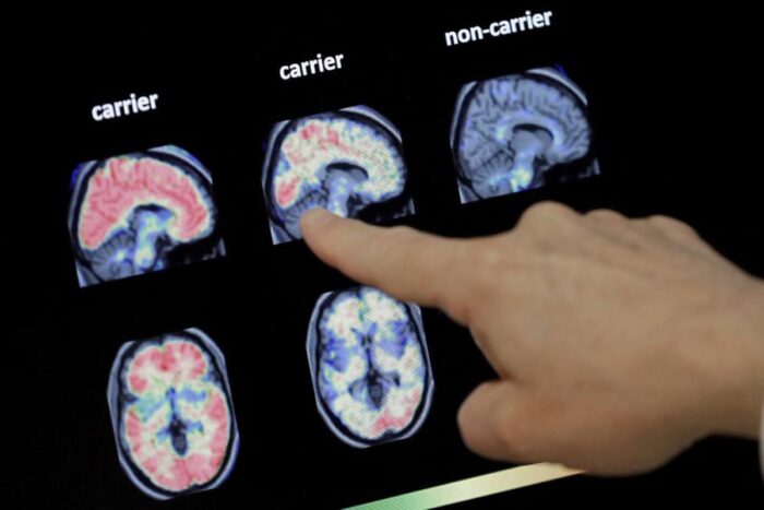 In this Aug. 14, 2018 file photo, a doctor looks at a PET brain scan at the Banner Alzheimers Institute in Phoenix. Two experimental drugs failed to prevent or slow mental decline in a study of people who are virtually destined to develop Alzheimer's disease at a relatively young age because of rare gene flaws. The results announced Monday, Feb. 10, 2020, are another disappointment for the approach that scientists have focused on for many years -- trying to remove a harmful protein that builds up in the brains of people with the disease.