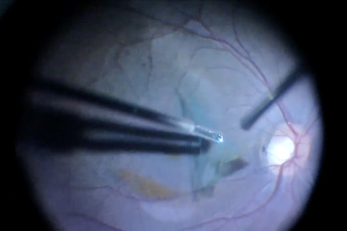 blown pupil treatment craniectomy