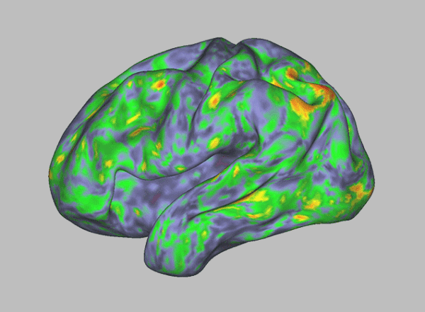 An animated image of a human brain seen from the side, with a changing pattern of blue, green, yellow, orange and red splotches.